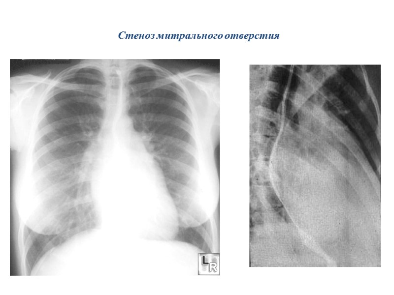 Стеноз митрального отверстия